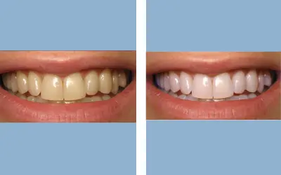 Before and After